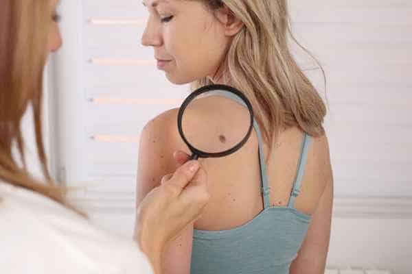 What Are Traditional Skin Lesion Removal Methods Stourport-on-Severn?
