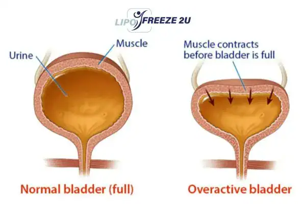 diagram of overactive bladder treatment Stourport-on-Severn