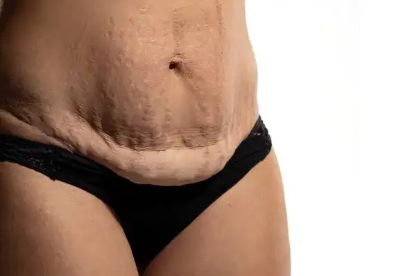 loose skin after weight loss injections Stourport-on-Severn