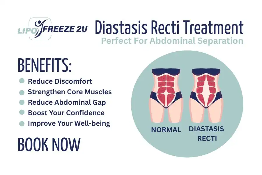 Benefits of body toning treatment Stourport-on-Severn for Diastasis recti