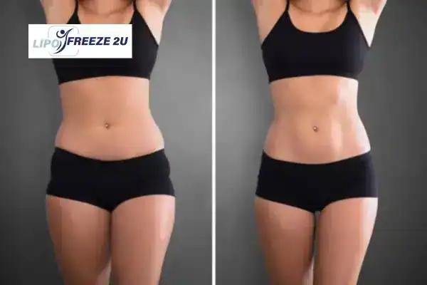 How Can LIPO FREEZE 2U Support Your Post-Pregnancy Body Recovery Stourport-on-Severn?