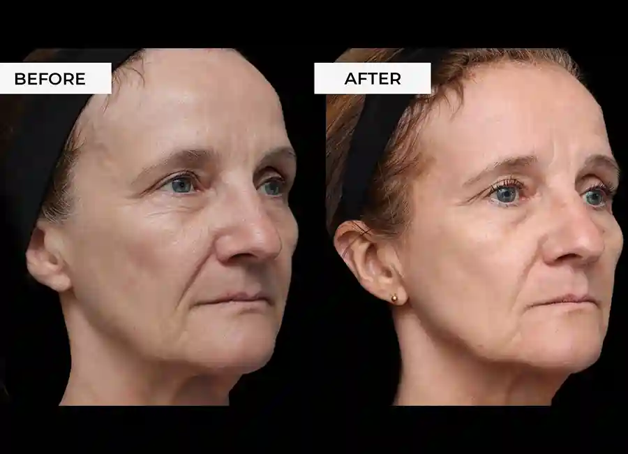 How Many RF Microneedling Sessions Will You Need to See a Difference Stourport-on-Severn?