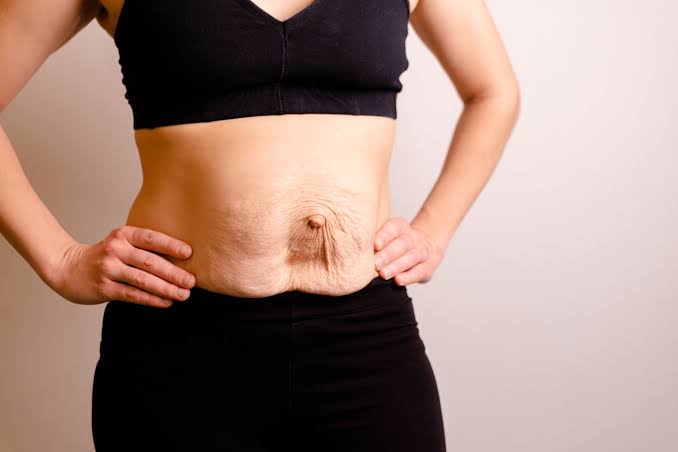 Is Surgery Really the Only Way to Repair Diastasis Recti Stourport-on-Severn?